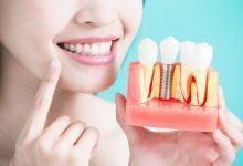 Dental Implant Surgery