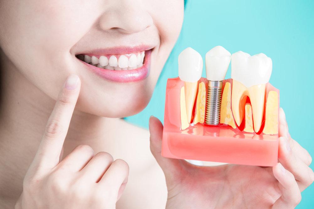 Dental Implant Surgery