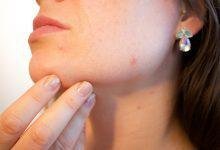 acne scars