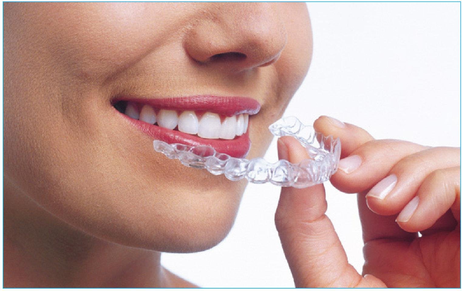 Clear Aligners: The New Way to Get Your Smile Straightened