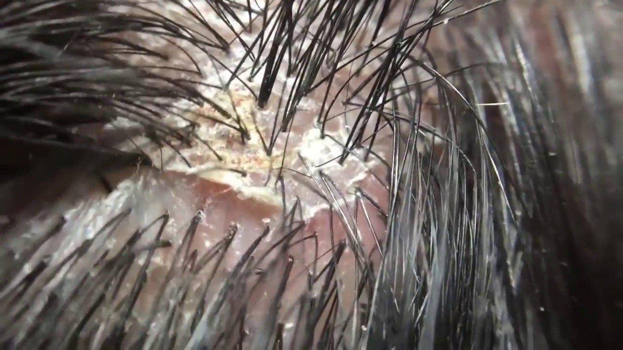 Dandruff Can Be Effectively Eliminated With Ketoconazole Shampoos