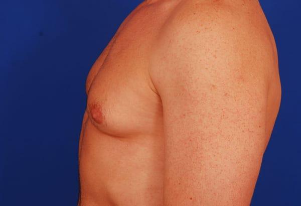 Gynecomastia