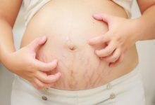 Overcoming Pain and Discomfort during the Stage of Pregnancy