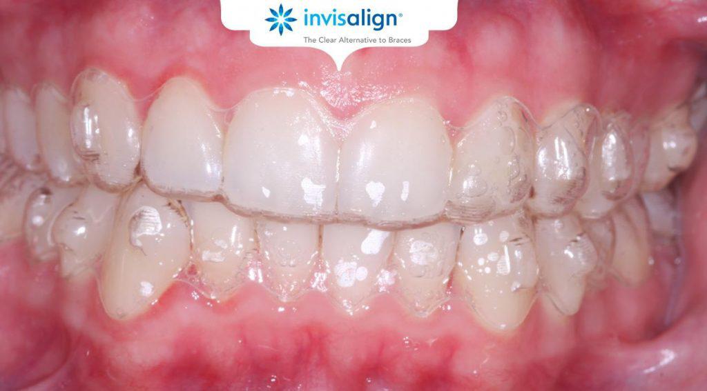 Fixed Braces or Invisalign