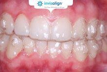 Fixed Braces or Invisalign